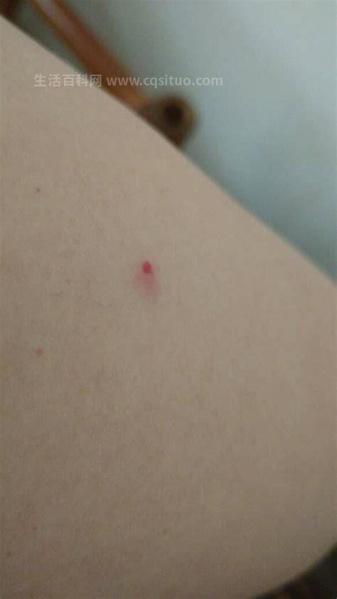 HPV初期小红点照片，病毒性疾病／HPV初期症状／HPV初期小红点的照片