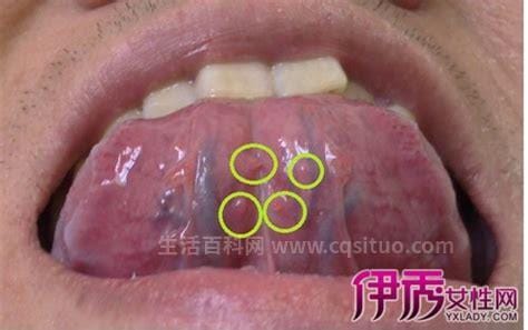 hpv感染舌头的初期图片，初期症状／相