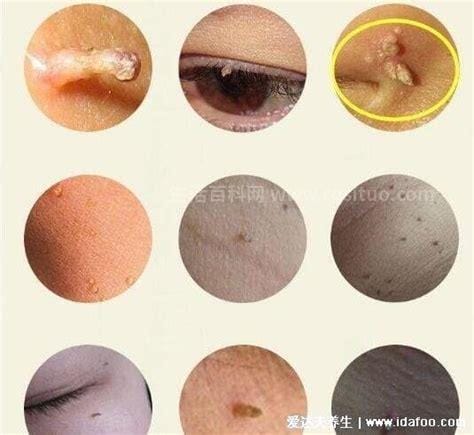 18种常见的皮肤病图片，湿疹／荨麻疹／带