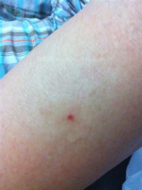 蜱虫咬人后的伤口图，咬时不觉疼痛几天后出现红斑或水肿