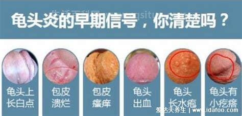 四种类型龟头炎症状图片对照，有红点丘疹会发展成溃疡的优质
