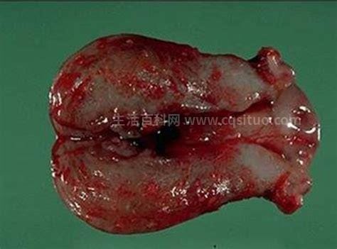 子宫内膜脱落真正图片，出现血块有肉