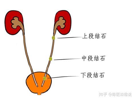 三个动作排出输尿管结石，分别是侧卧
