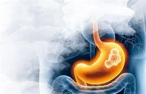 胃癌发出的第一个信号，往往误认为是胃痉挛和胃炎优质