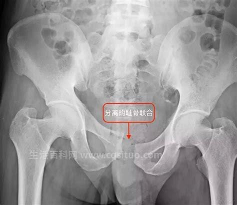 耻骨痛在哪个位置图片，位于髋骨的前下部优质