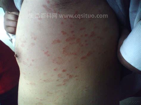 玫瑰糠疹图片初期症状，淡红色斑有鳞