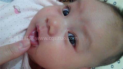 婴儿鹅口疮图片早期症状，上颚出现米