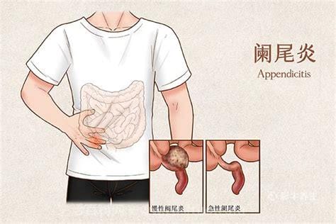 阑尾炎发病有三大前兆，分为右下腹痛／发热乏力／上腹部不适优质