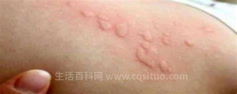 最真实螨虫叮咬后的症状图片，如果脸上皮肤被螨虫叮咬会溃烂优质
