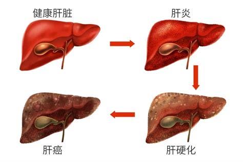 三个症状说明有肝癌了，出现消瘦乏力/消化道症状/发热优质