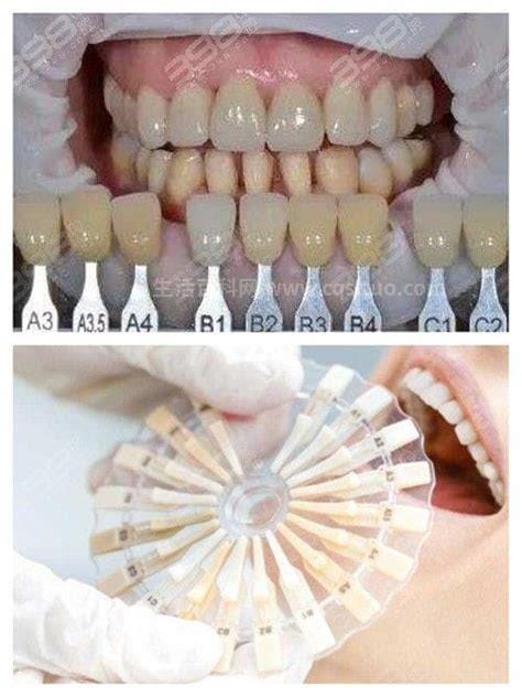 为什么千万不要做牙齿贴面优质