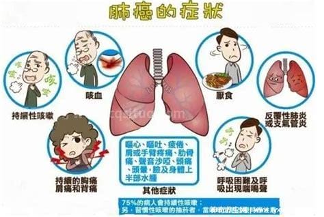 肺癌早期八个信号，出现痰中带血或咯血约占30%优质