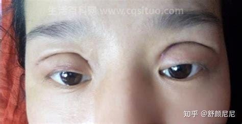 割双眼皮十个有九个后悔，主要手术后带来的并发症优质