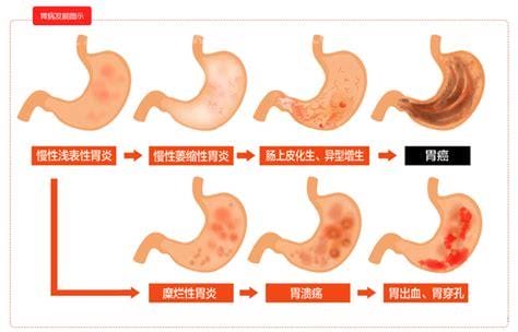胃病的五大早期症状，大家牢记胃病的五大信号优质