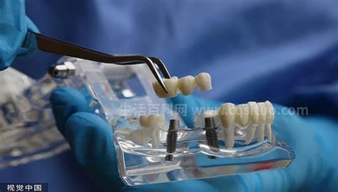 医保局：种植牙暂不入医保（2022医保种植牙新规定）优质