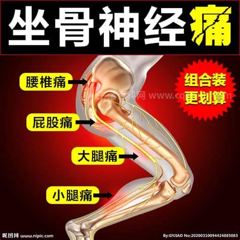 坐骨神经痛的疼点图，单侧腰部到脚底