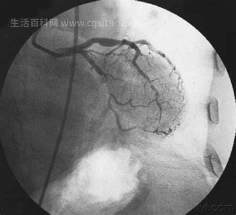 做完心脏造影后悔死了，主要存在着很