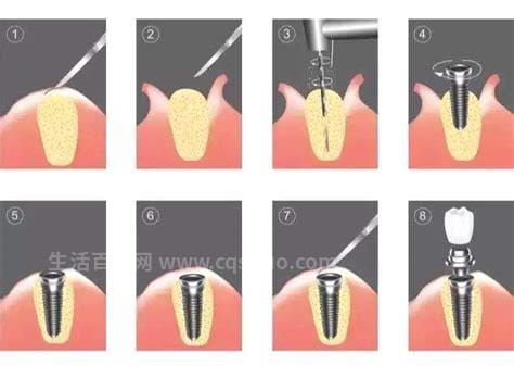 种植牙的过程步骤图解，检查口腔后种植体安装优质