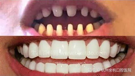 良心牙医不建议做全瓷牙优质