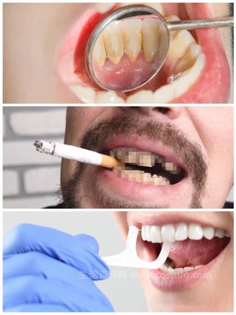 医生不建议清理牙结石，这三种人不建