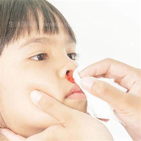 小孩鼻子出血七种原因，分别是鼻炎／鼻