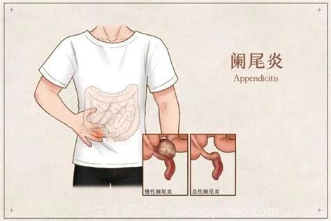阑尾炎的疼痛位置图片，在于右下腹肚