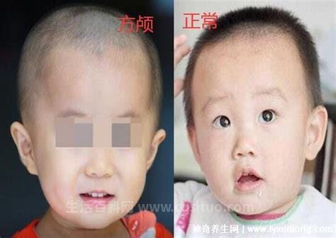 婴儿方颅图片和正常对比头型图片，上至下看前额突出优质