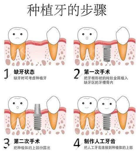 种植牙多少钱一颗2023价格表，国产50