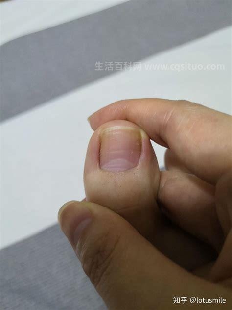 最轻微的初早期灰指甲图片，出现两种