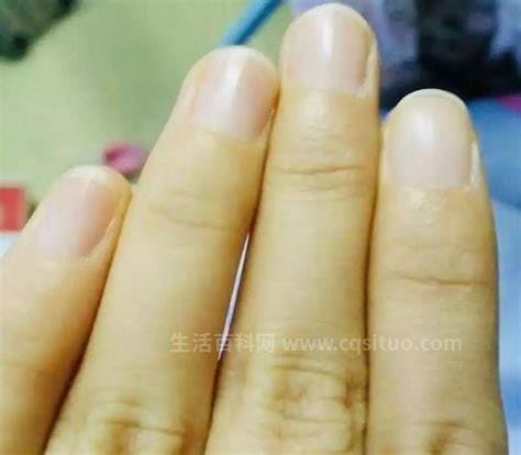 指甲竖纹当心三大疾病，警惕有黑色竖
