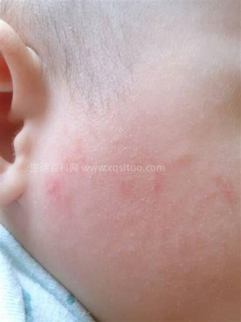 婴儿皮肤过敏怎么办,宝宝身上痒痒