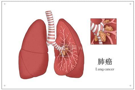 肺癌的八个早期征兆，出现痰中带血或