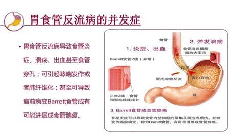 我的胃食管反流彻底好了，只要你掌握