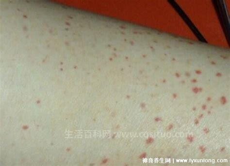 HPV初期小红点照片图片长在哪里,来了解一下这种病毒感染的区别优质