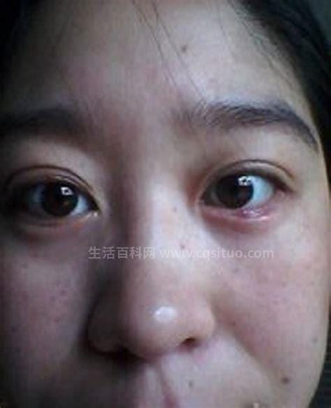 初早期麦粒肿图片及症状，出现红肿疼痛的脓疱情况,右眼下眼睑得了麦粒肿，脓◑已经流出来了，可优质