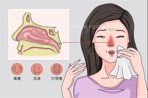 怎么治过敏性鼻炎,过敏性鼻炎怎么缓解 浅谈缓解过敏性鼻炎5优质