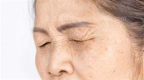 脸上长老年斑怎么去掉最快的方法,如何去除老年斑 6种偏方赶走老年斑优质