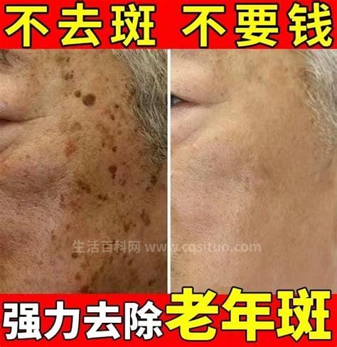 脸上起老年斑怎样去除最有效，涂抹维生素a（3个小方法）,老年斑用什么药膏能抹好优质
