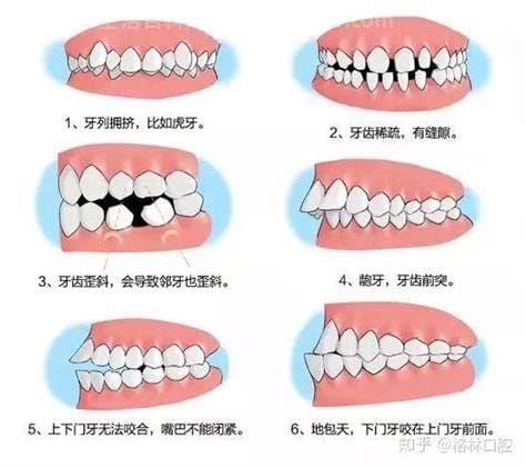 牙齿矫正最佳年龄段，12-18岁无年龄