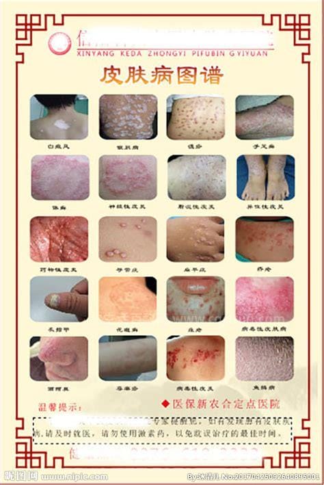 看图识✿病皮肤科图片及名称，全网最详细100种皮肤病的合集,最难治的皮肤病排行有哪些优质