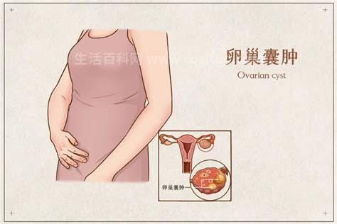 卵巢囊肿手术怎么做
