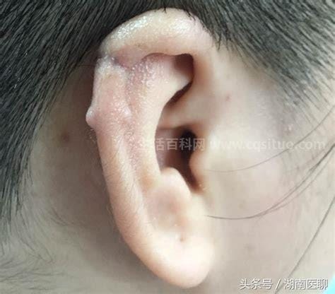 耳洞经常发炎流脓怎么办