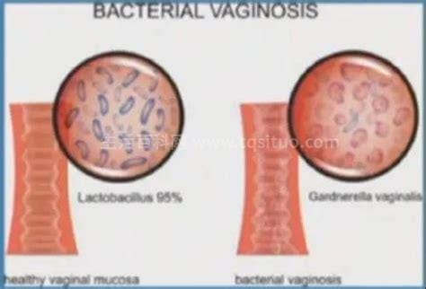 为什么会得细菌性阴道炎