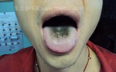 舌头上出现黑苔是怎么回事