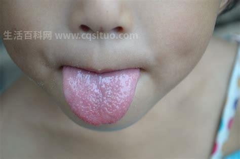 小孩舌头口腔溃疡照片