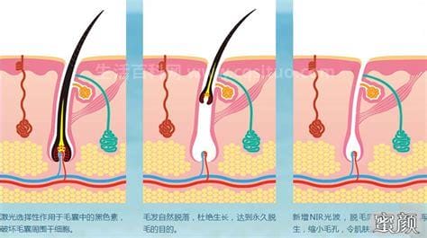 有没有永久脱毛的方法,有没有永久脱毛的方法?