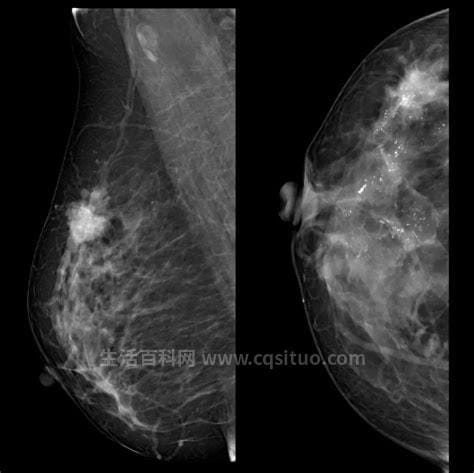 乳腺癌的早期症状图片,乳腺癌有多