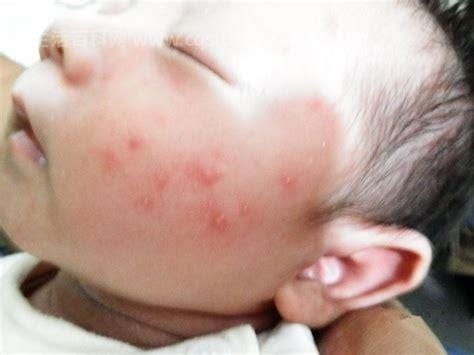 宝宝幼儿急疹初期图片,十个月宝宝发完烧后身上长疹