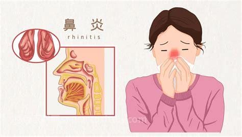 过敏性鼻炎的症状有哪些表现,重度