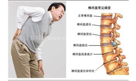 腰间盘突出患者会影响正常生活和工作吗,腰椎间盘突出的锻炼方法有哪些视频